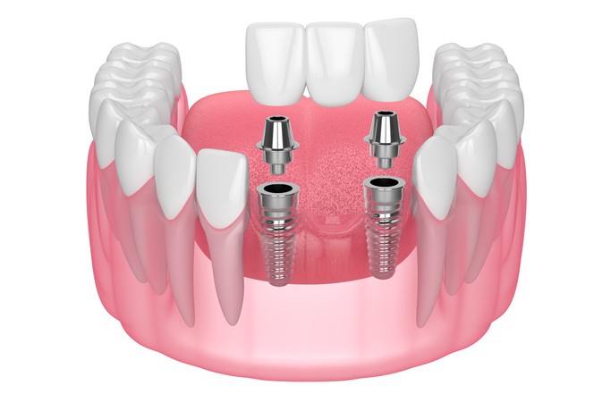 multiple tooth implants