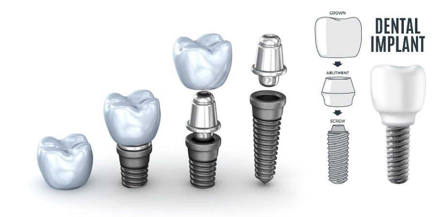 single tooth relacement implant